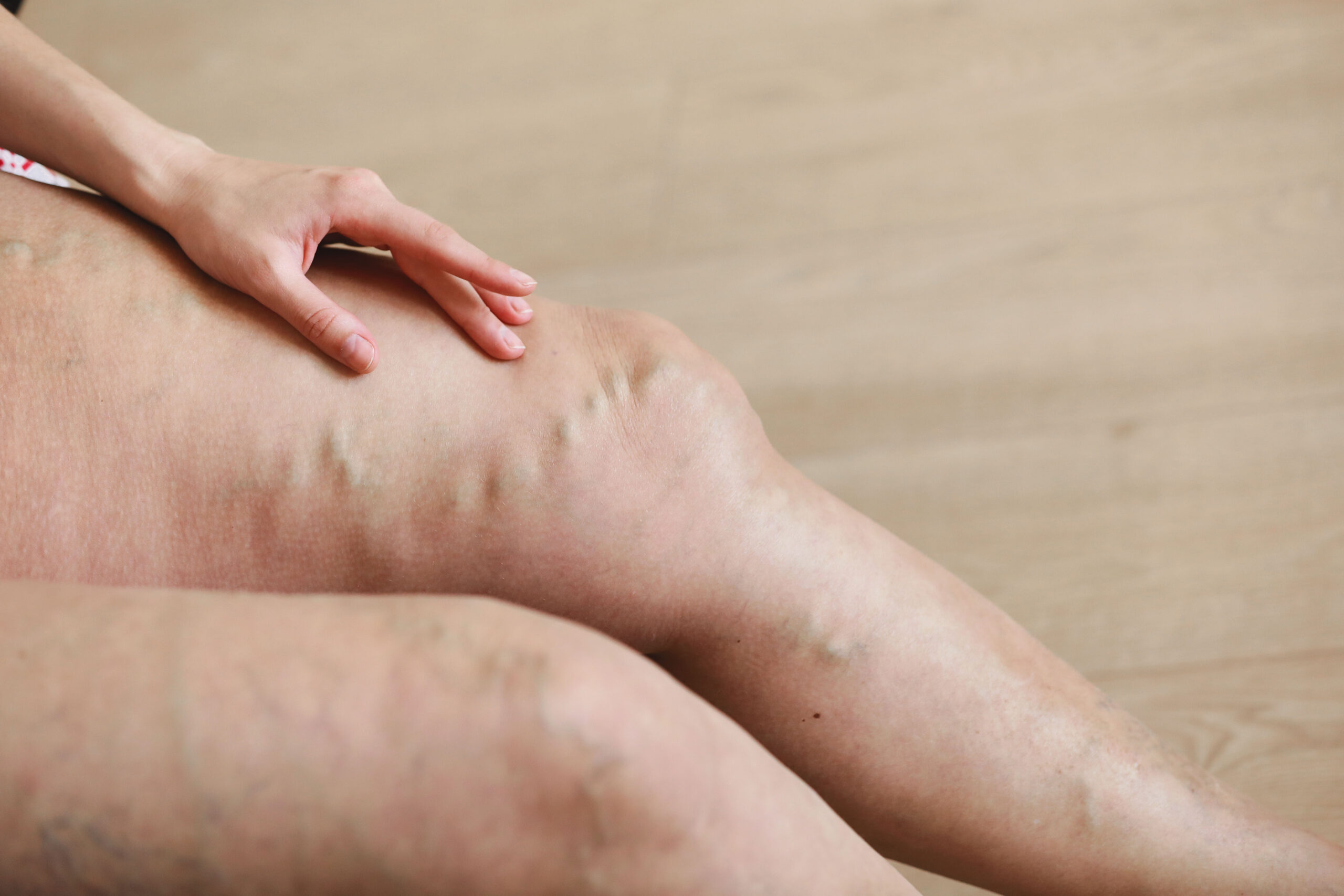 Is Sclerotherapy Painful? Understanding What the Procedure Entails