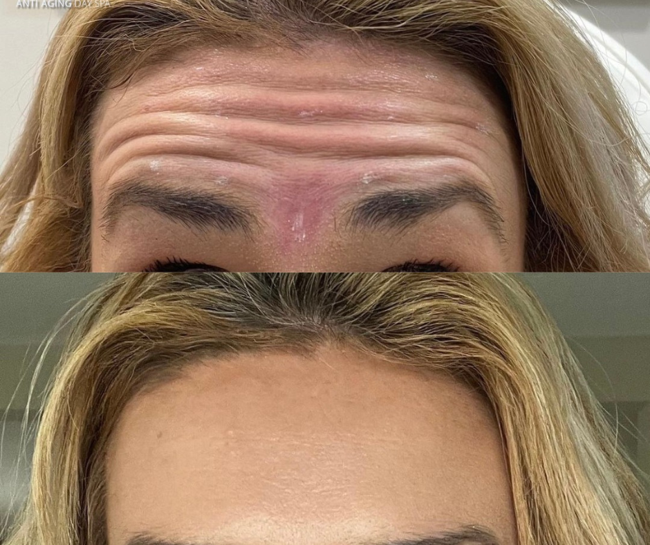 When to Start Using Xeomin: A Comprehensive Guide to Wrinkle Prevention