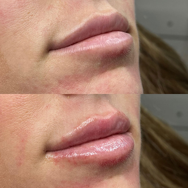 Before and After Lip Enhancement