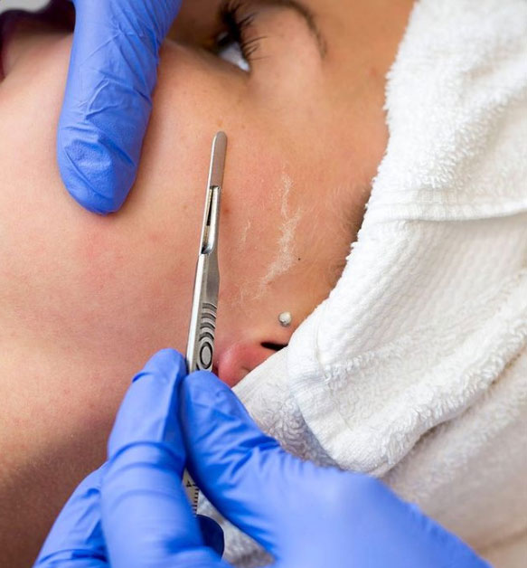 Best Dermaplaning in Estero, FL