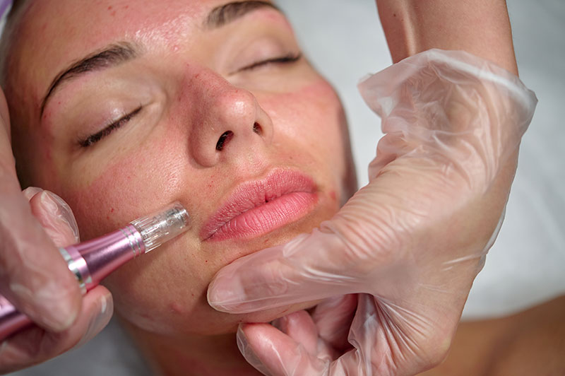 Best Microneedling in Estero, FL