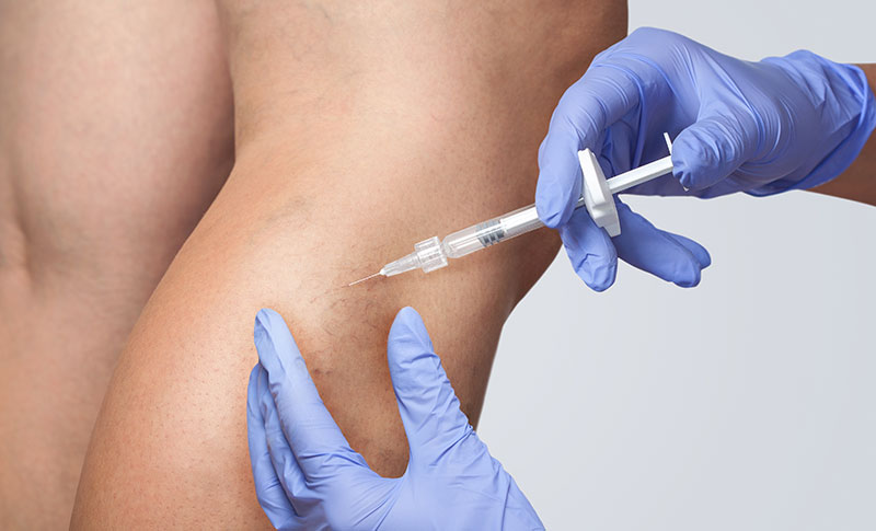 Sclerotherapy Procedure