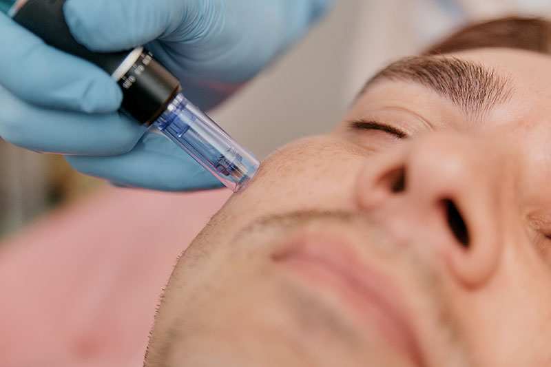 Candidate for Microneedling