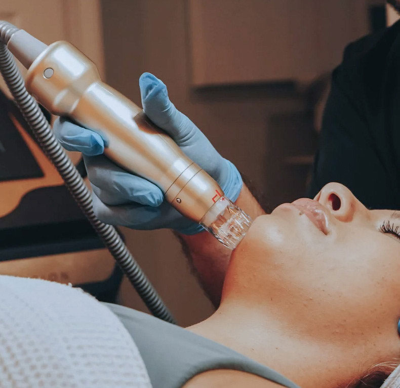 Radiofrequency (RF) Microneedling