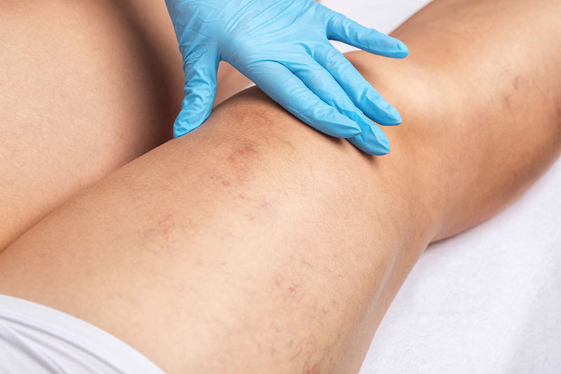 Sclerotherapy