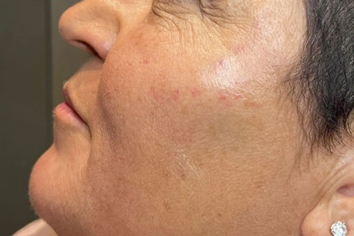 Close-up of a woman's cheek with smoother skin texture