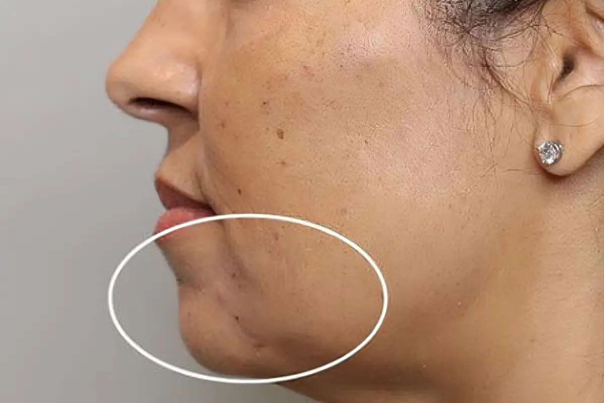 Side profile of a woman's jawline with the jaw area circled
