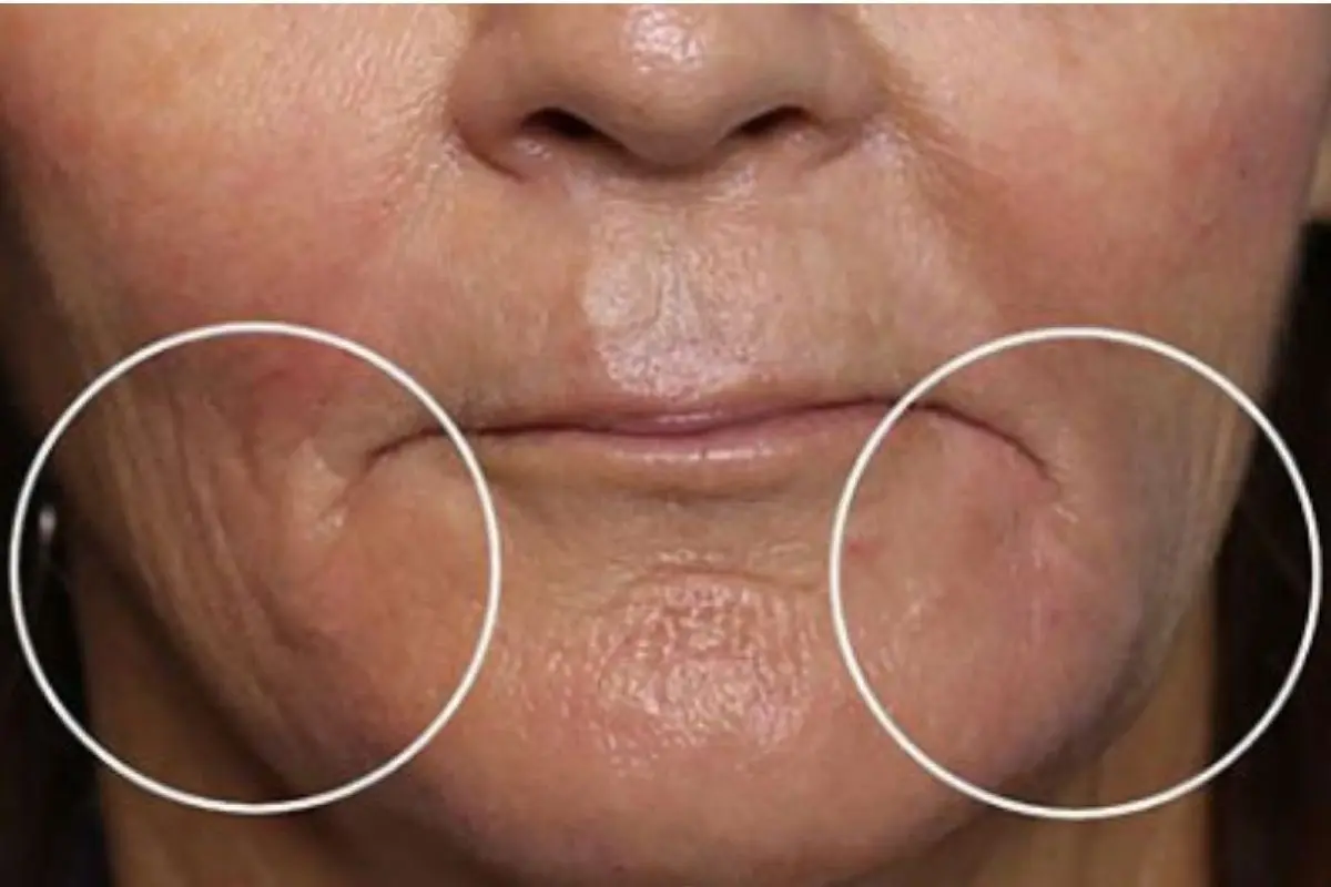 Close-up of the mouth area with lines at the corners circled