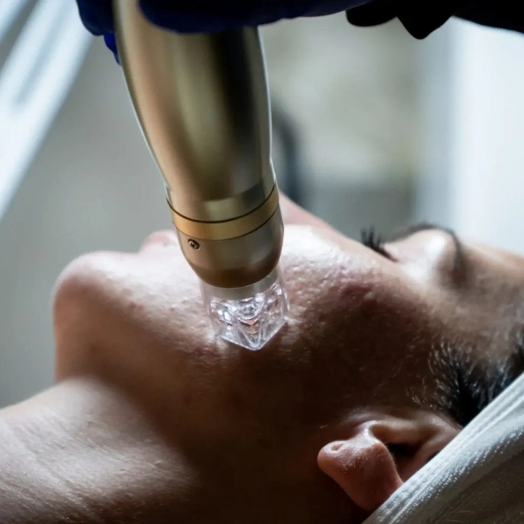 TLLS Estero RF Microneedling