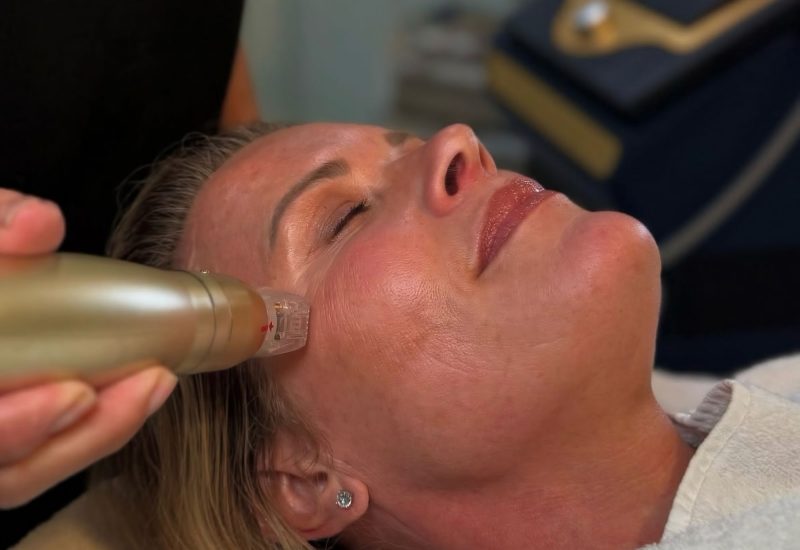 TLLS Estero RF Microneedling