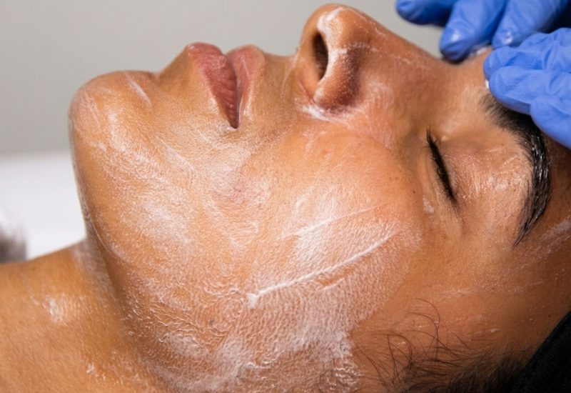 TLLS Estero Checmical Peel